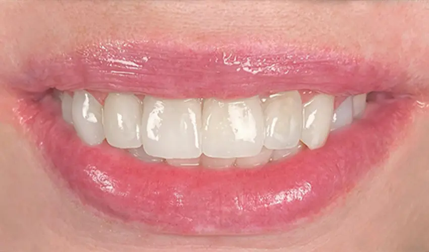 After dental veneers transformation Las Vegas patient 3